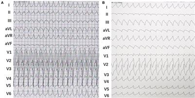 Electrophysiological characteristics of right- and left-sided Mahaim accessory pathways: A single-center experience in China